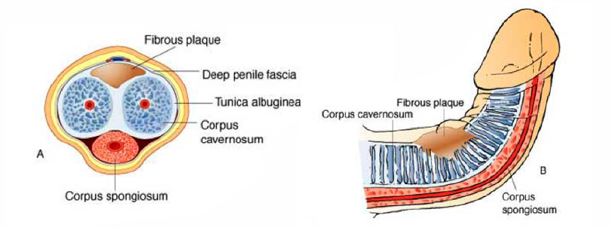 img-curvaturas-peneanas1-alejandro-carvajal-sexualidad-fertilidad